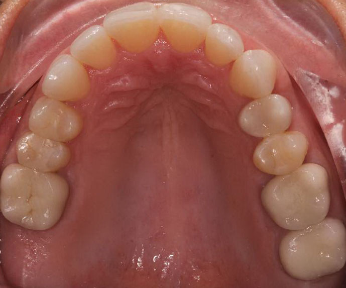 crowding of the teeth after